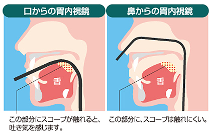 内視鏡説明イラスト