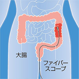 ファイバースコープイラスト