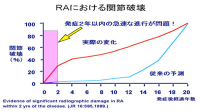 RAにおける関節破壊